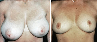 Dr. Rose Breast Reduction 