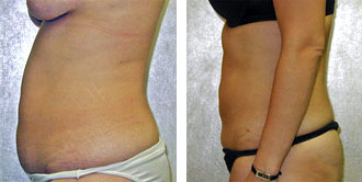 Dr. Rose Abdominal Liposuction 