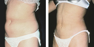 Dr. Rose Abdominal Liposuction 