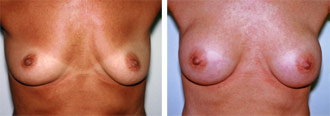 Dr. Rose Abdominal Liposuction 