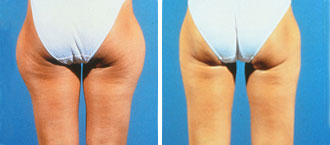 Dr. Rose Abdominal Liposuction 