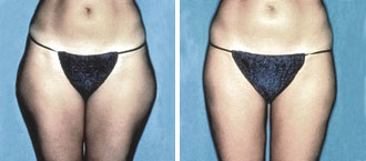 Dr. Rose Abdominal Liposuction 