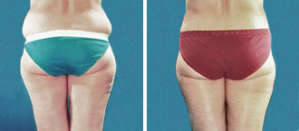 Dr. Rose Abdominal Liposuction 