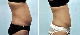 Dr. Rose Abdominal Liposuction 