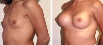 Dr. Rose Abdominal Liposuction 