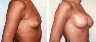 Dr. Rose Abdominal Liposuction 