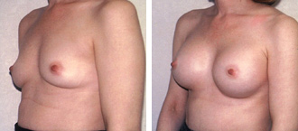 Dr. Rose Abdominal Liposuction 