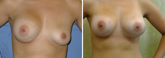 Dr. Rose Abdominal Liposuction 