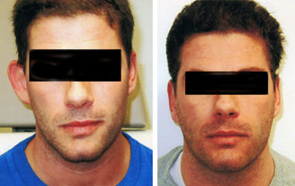 Dr. Rose Abdominal Liposuction 